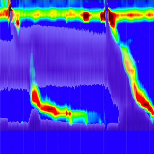 High Resolution Esophageal Manometry